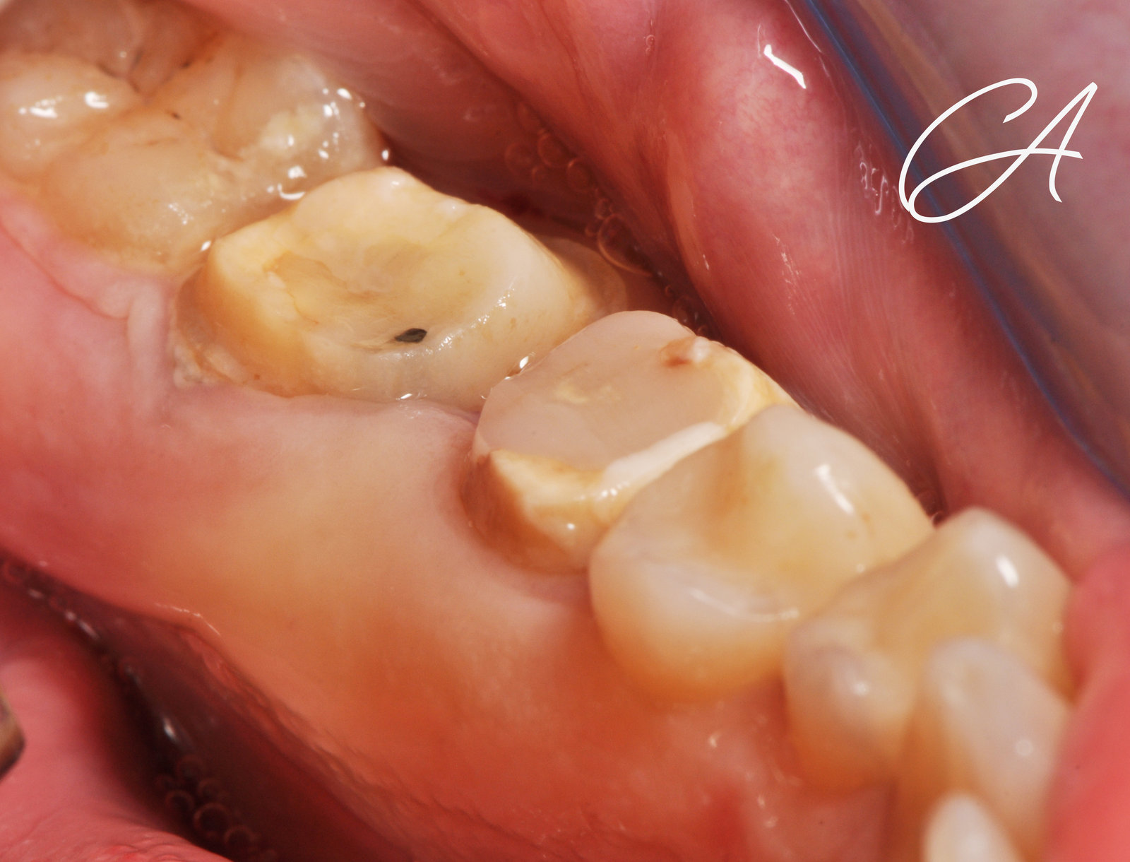 Denti troppo corti per una corona? Allungamento di corona